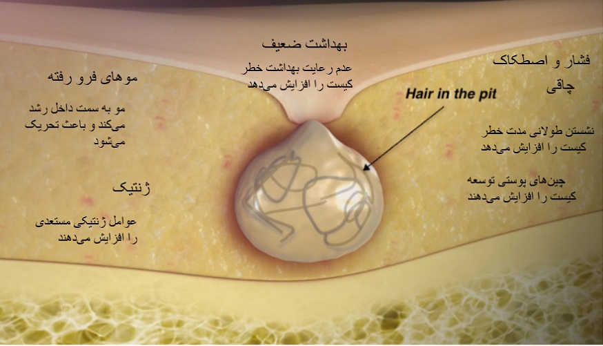 کیست مویی چیست